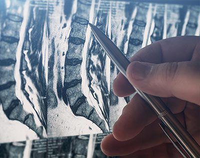 spinal scans for someone with degenerative disc